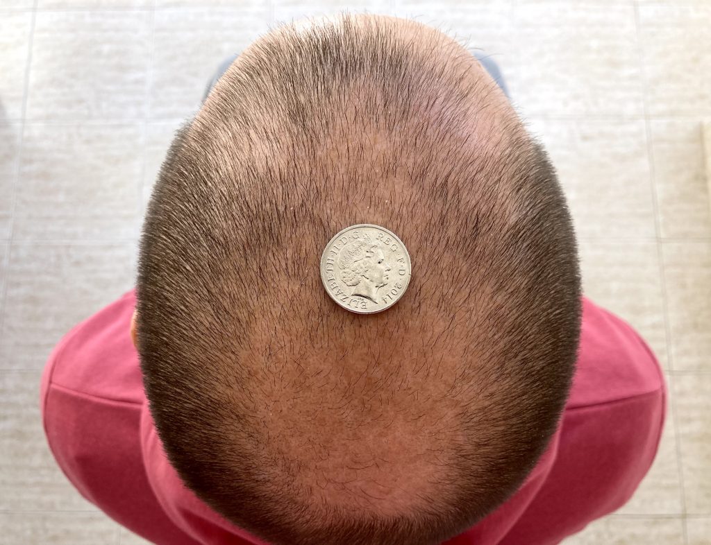 Hair loss graft calculator